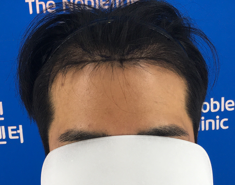 부산에서 서울까지 찾아가서 모발이식 받은 후기