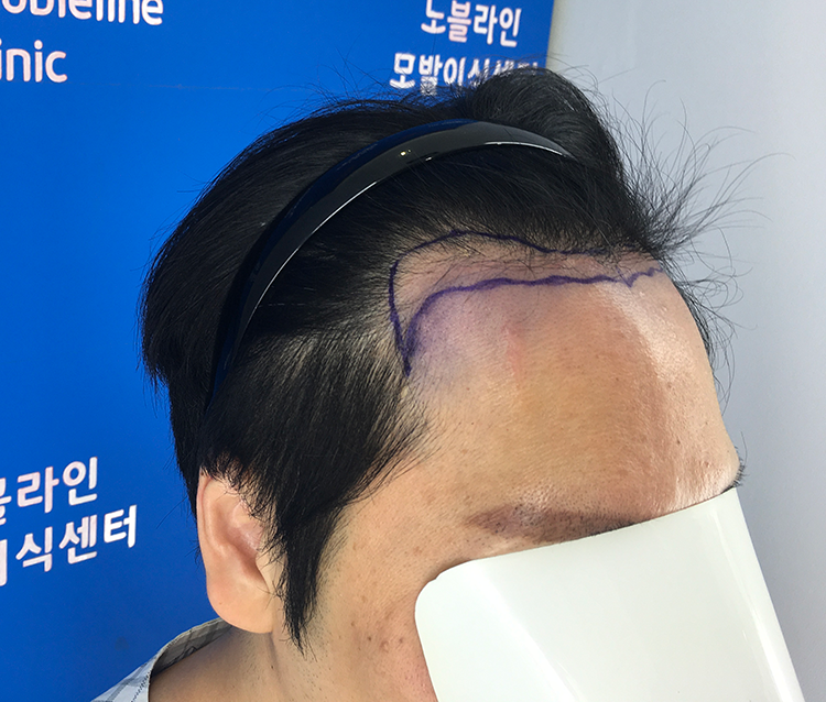 7개월 매우 좋아졌습니다.