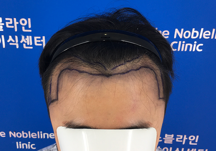 백원장님께 4377모 M자 고밀도 이식 받았습니다.