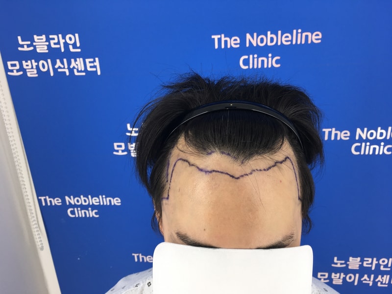 It's the 135th day of Baekhyun-wook's surgery in The Nobleline Center for Alopecia Care.