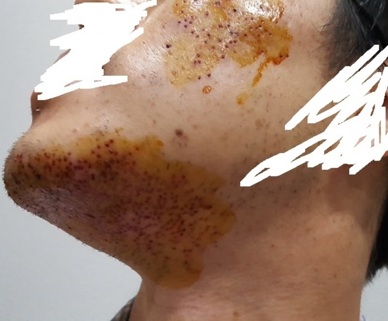 턱수염 및 볼의 털 채취.jpg