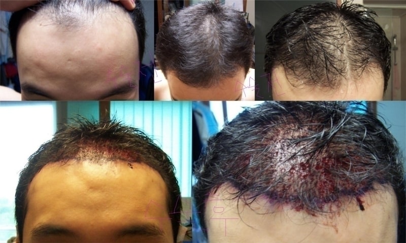 일괄편집_수술 전 후(편집).JPG