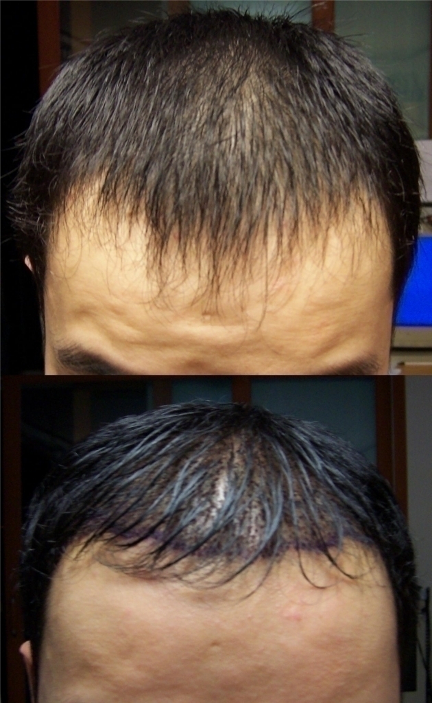 수술전후(7일째).jpg
