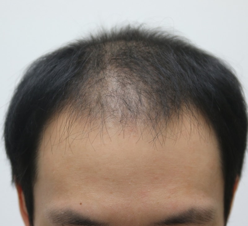 비절개 19일차 후기 올립니다