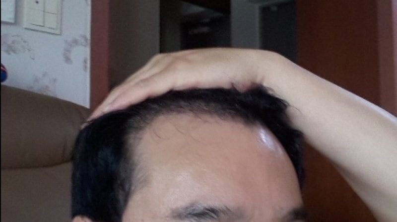 포헤어 1300모낭 일주일지났습니다