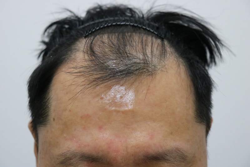 머리숱 많아져서 젊어졌습니다