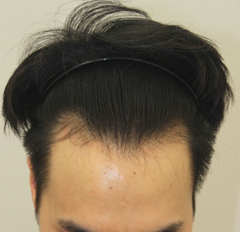 적금깨서 포헤어에서 수술하고 왔습니다
