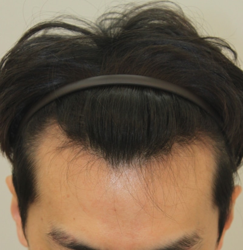 포헤어에서 M자 1200모낭 채웠습니다