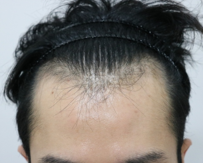 비절개 3500모 3개월 됐습니다