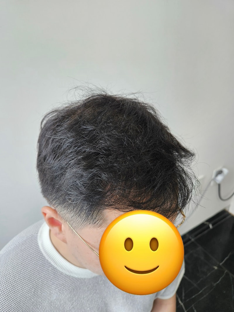 Eight months after the non-excisional hair transplant