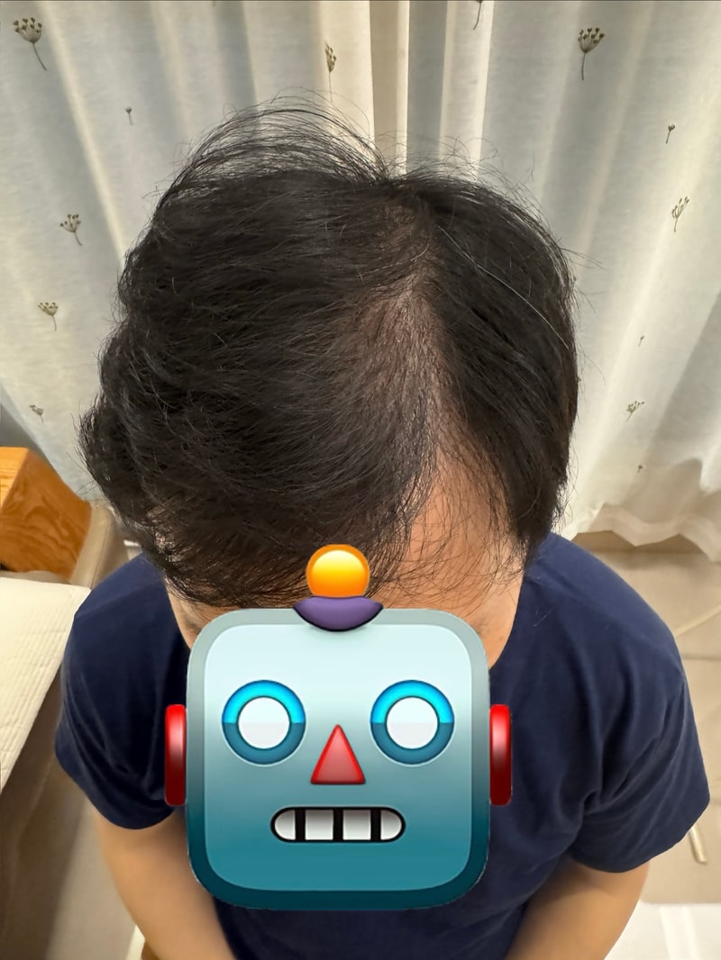One year after non-excisional hair transplantation