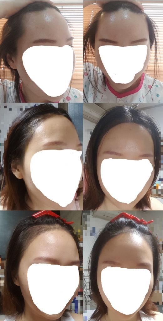 모발이식 실밥제거후.png