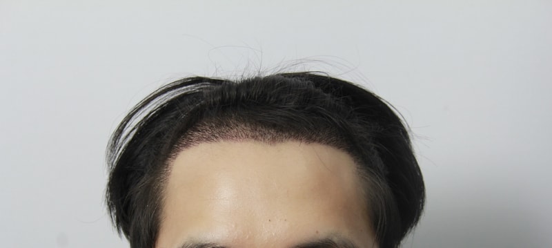 3주경과 11.JPG