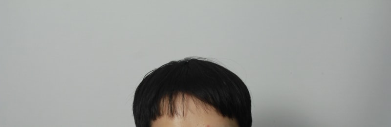 모아트의원에서 비절개수술하고 4개월경과후기입니다.
