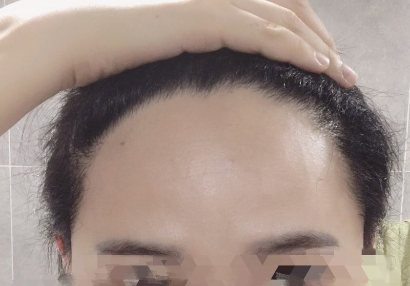 뉴헤어 6개월 경과