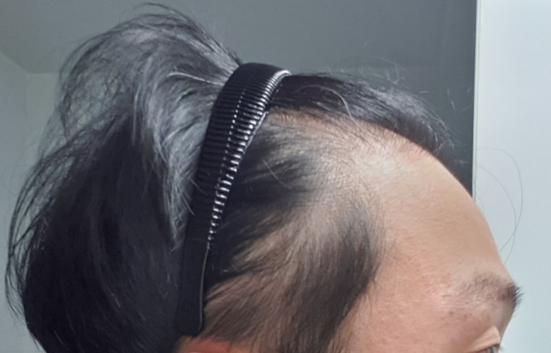 수술전셀카우측.jpg