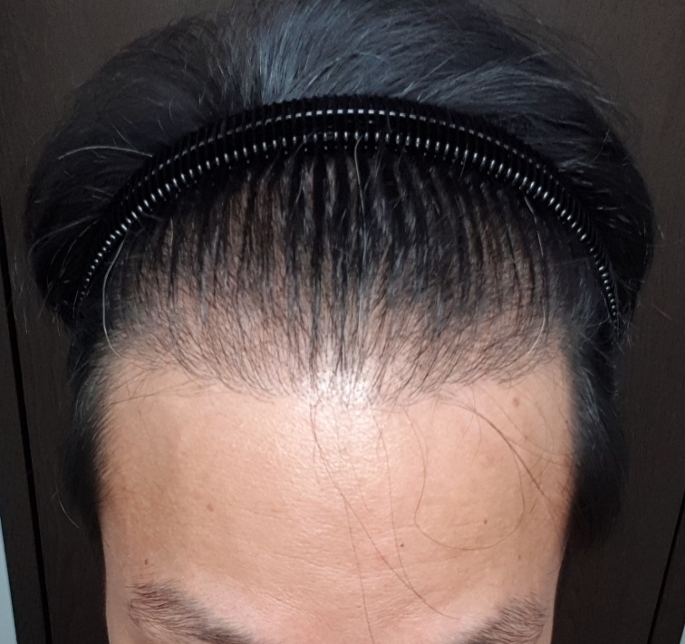 수술전셀카위.jpg