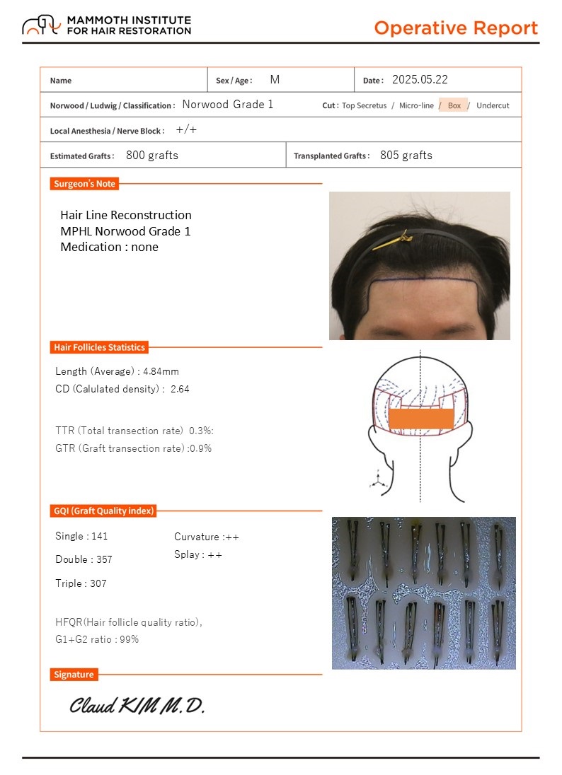 Busan Hair Transplantation Slit Method Mamos M-shaped Surgery Day Review