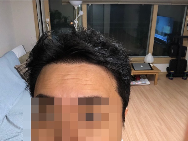 수술받고 3년차 다 되어갑니다.