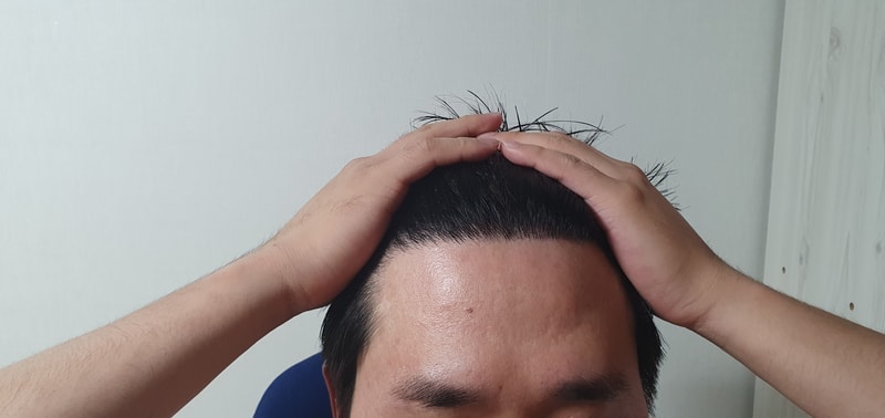 비절개 1256모 M자 12개월차 후기