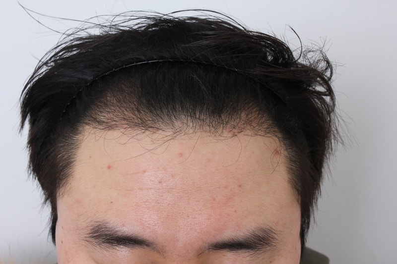 6개월경과 (2).JPG