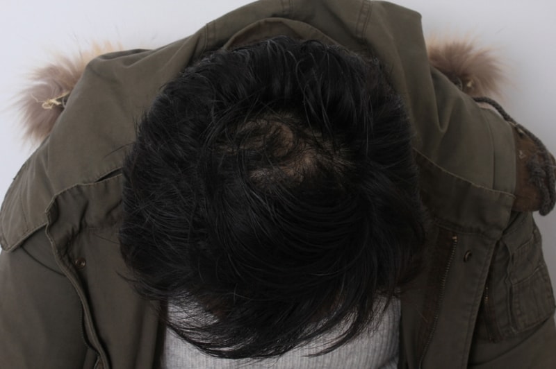 6개월 정수리.JPG