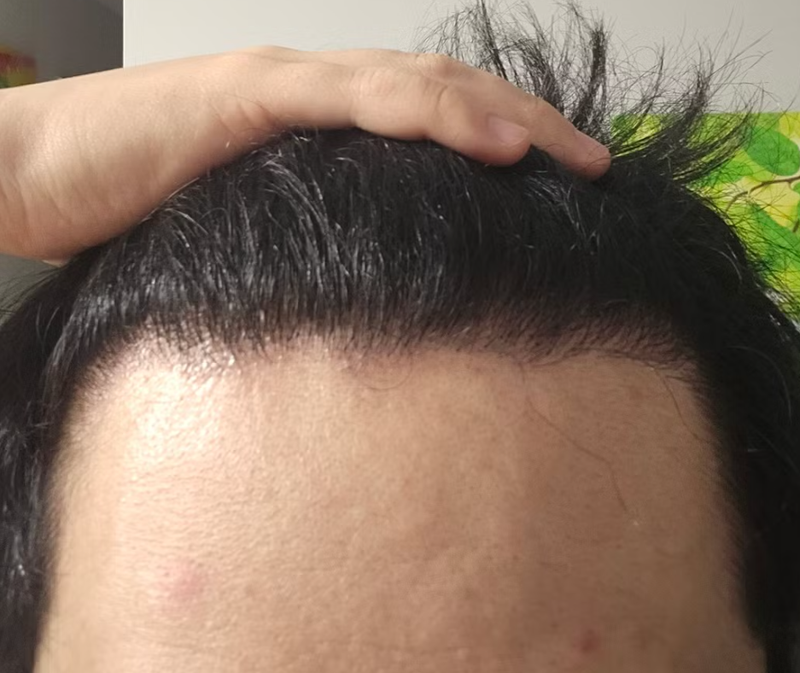 모발이식 대망의 6개월차