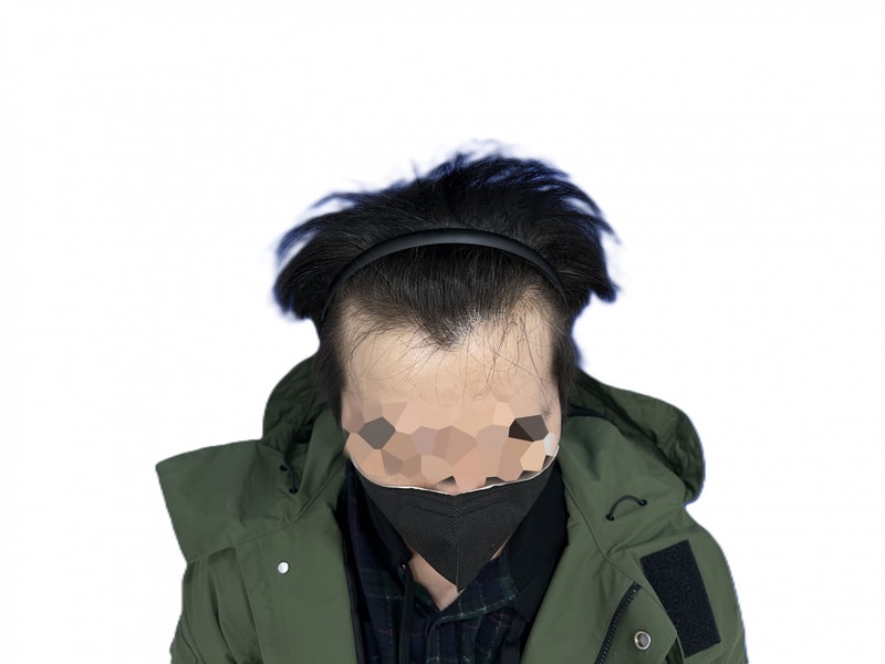 시간 참 빠르네요 모디헤어플란트 2700모 심은지 6개월차입니다