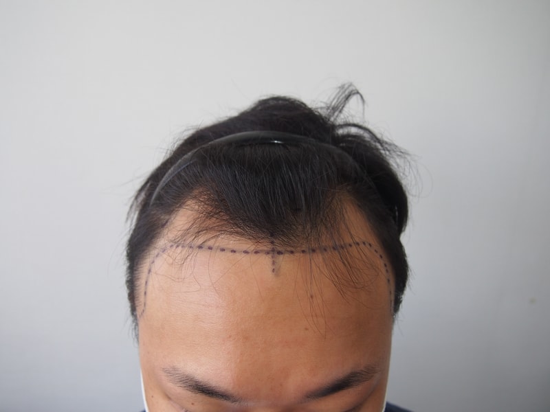 비절개(4,336모) 모발이식(비절개) 4개월차 후기