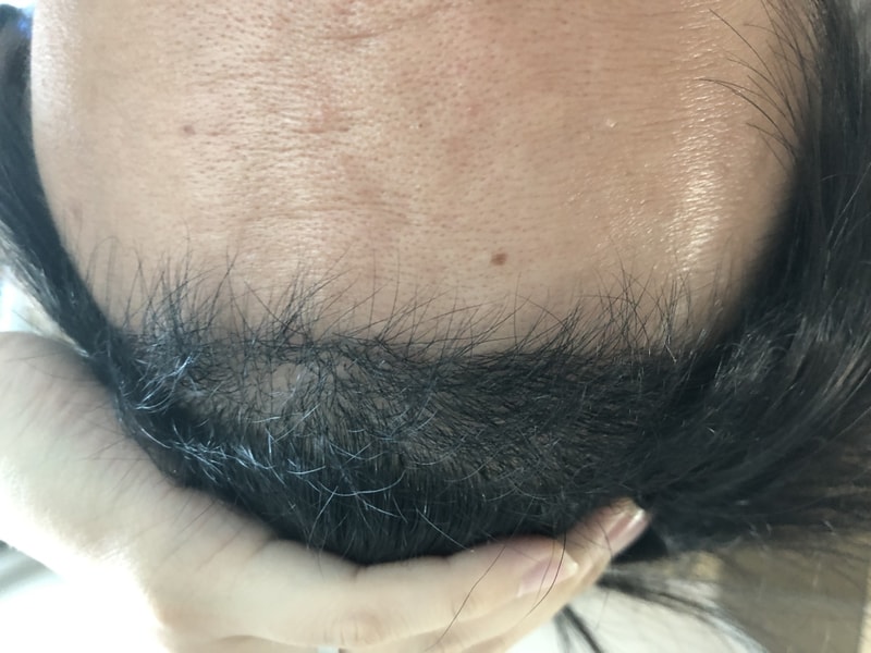 모재성 1400모낭 비절개 4개월차