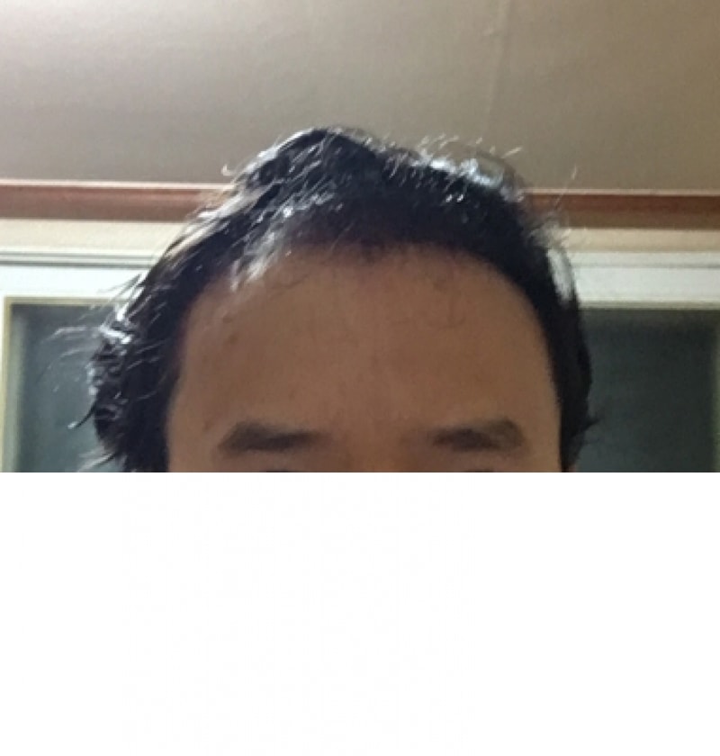 수술후 셀카.png