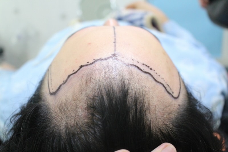 수술전 디자인.jpg