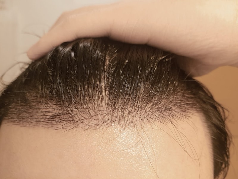 13일차 딱지 제거후 사진 올려봅니다.