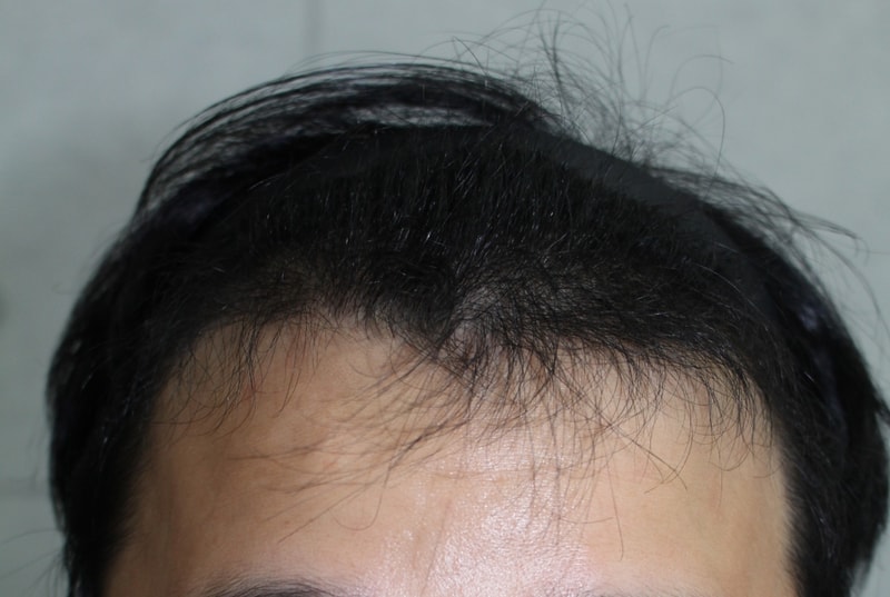 수술후 3개월 정면.JPG
