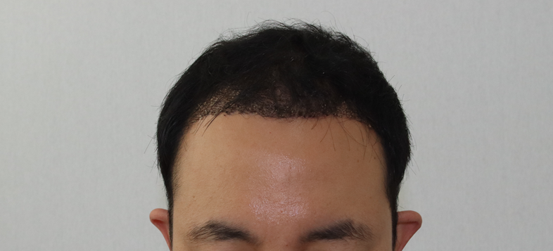 [모디헤어플란트] 6개월 경과 후기