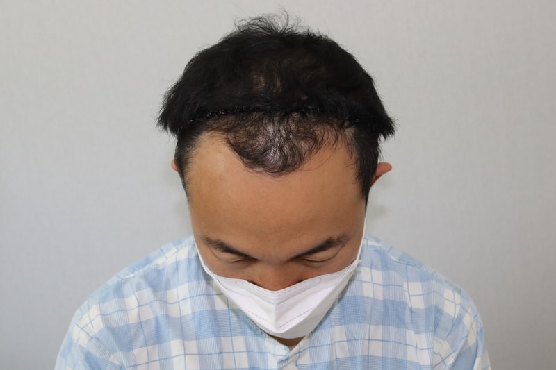 [모디] 9개월 경과 사진