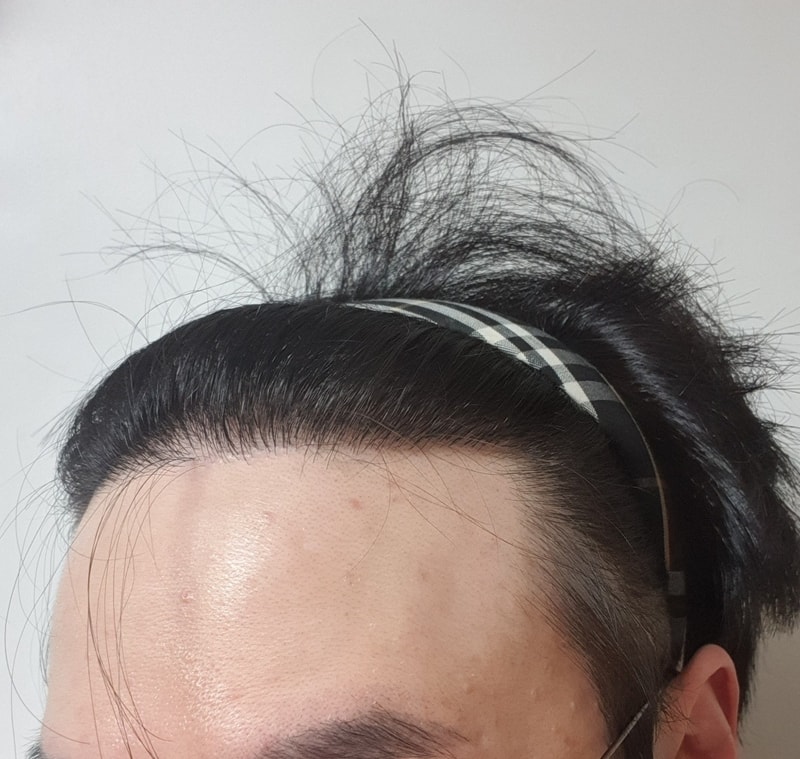 수술 후왼쪽.jpg