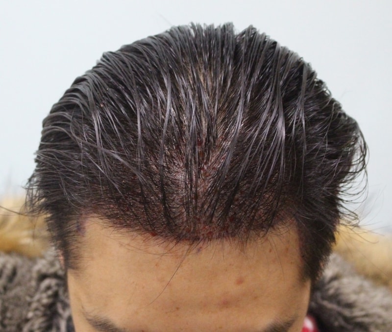 수술직후 (10).JPG