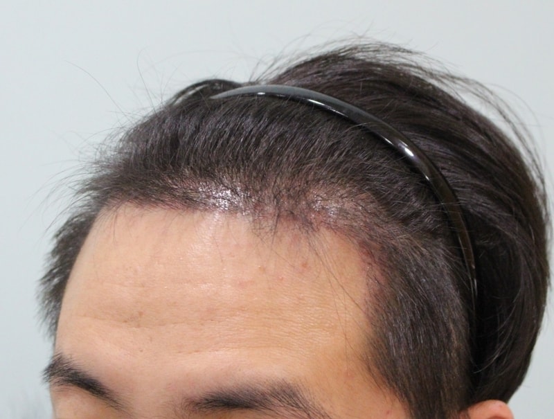 수술후 10일 (9).JPG
