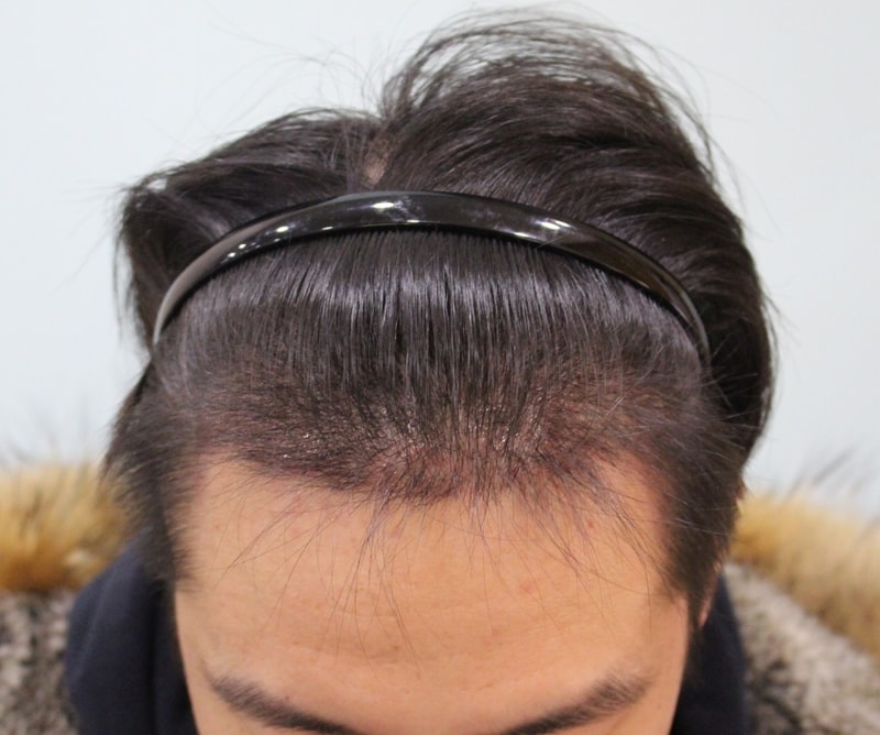 수술후 10일 (8).JPG