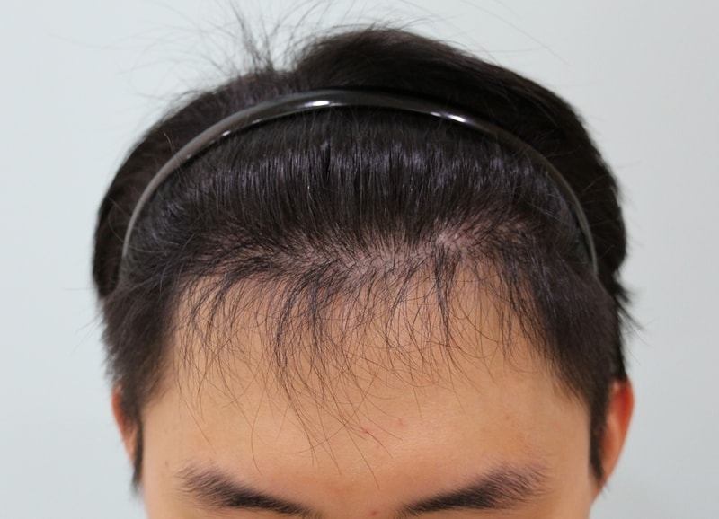 수술후 6개월 (5).JPG