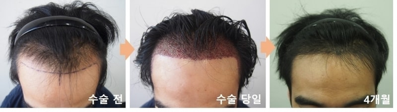 1600모낭 4개월 경과