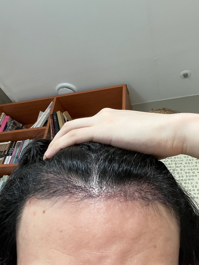 手術して144日になりました。 左右の差を見てください。うまくいってるのか不安です
