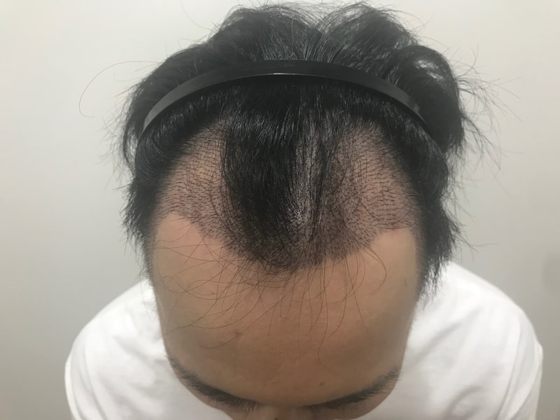 수술 10일 후.jpg