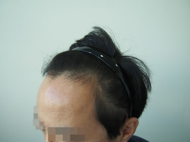 수술전 좌측.JPG