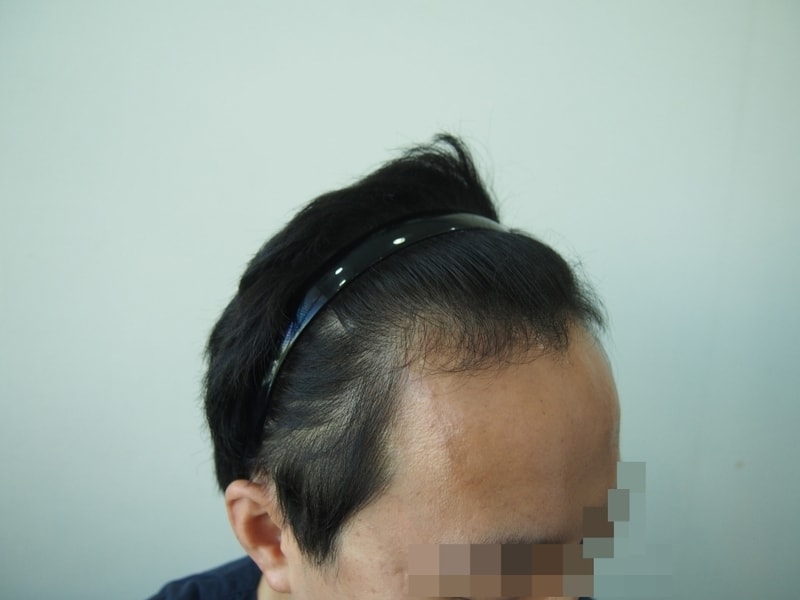 수술전 우측.JPG