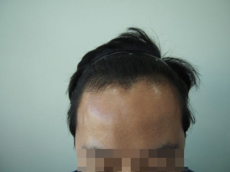 수술전 정면.JPG
