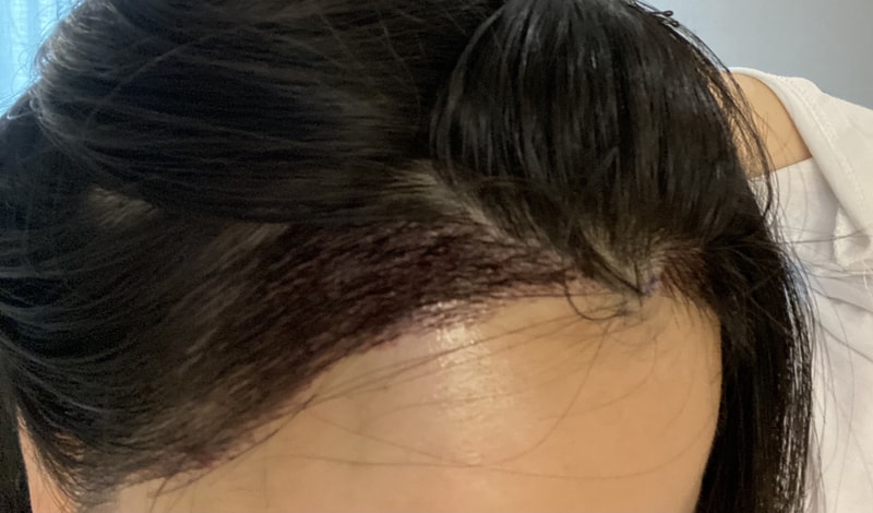 절개 6일차 입니다 ~