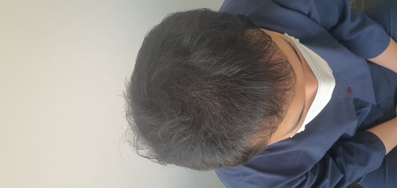비절개 1300모낭 1일차 수술 후기.