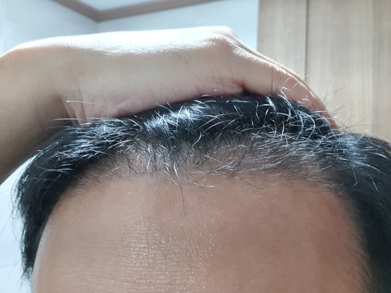 모발이식 3달 경과